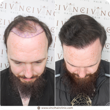 Before and After of UK Hair Transplant patient. comparison of thin crown and receded hairline to full dense head of hair after transplant.